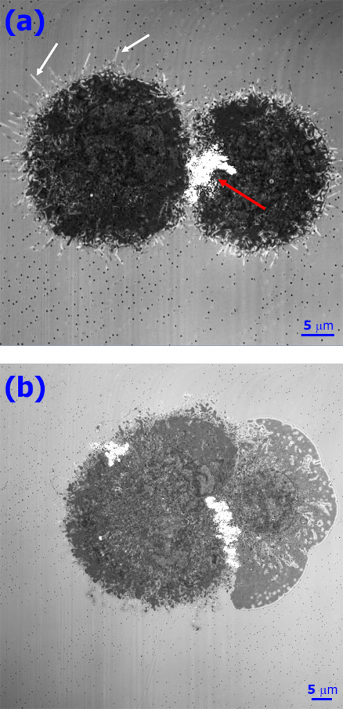 Разрушение двух злокачественных клеток наночастицами оксида железа ​под действием переменного магнитного поля